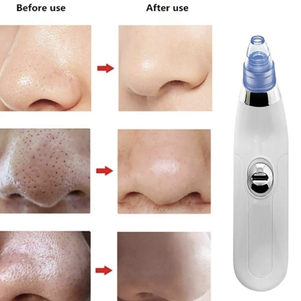 Derma Suction 5 In 1 Black Head Remover Machine Acne Pimple Pore Cleaner Vacuum Tool Rechargeable Machine